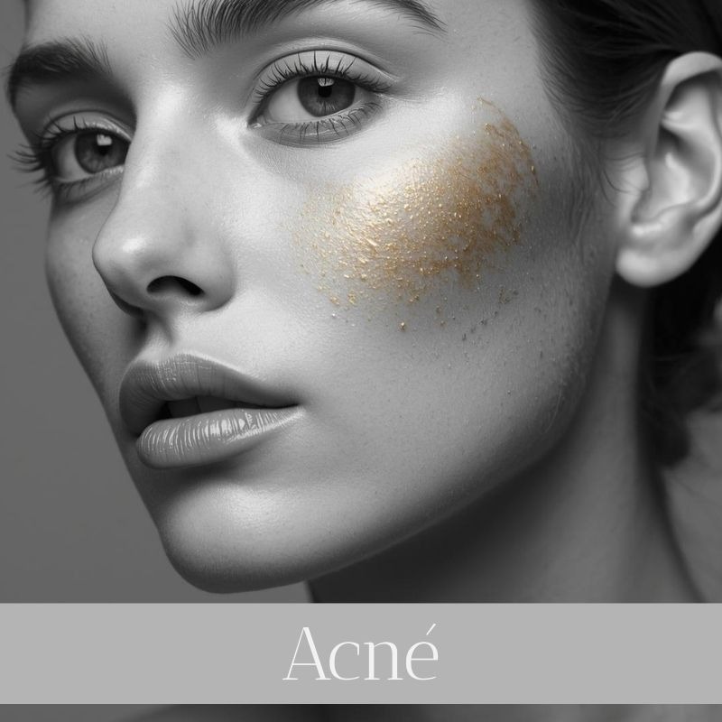 ulta online para el acné